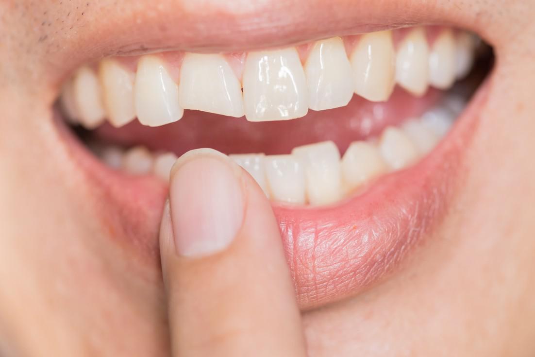 Are There Options for Repairing Severely Damaged Teeth?