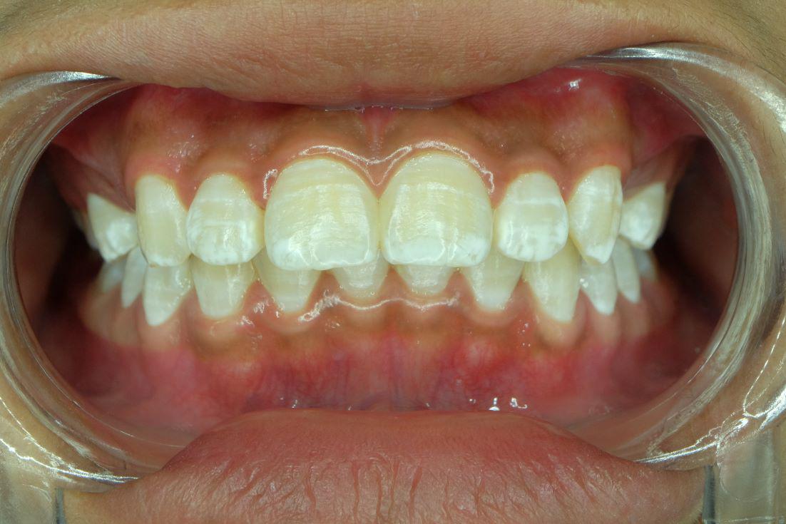 Why Do I Have White Spots on My Teeth?