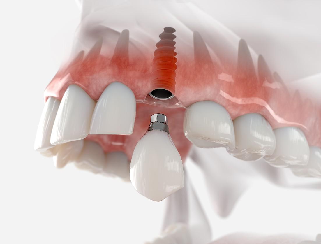 Implants vs Dentures :  Which is Right for You?