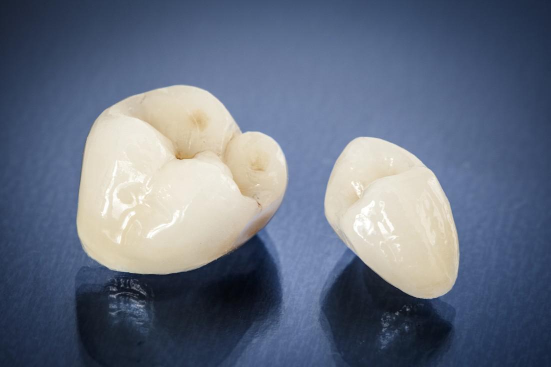 Dental Crown Options